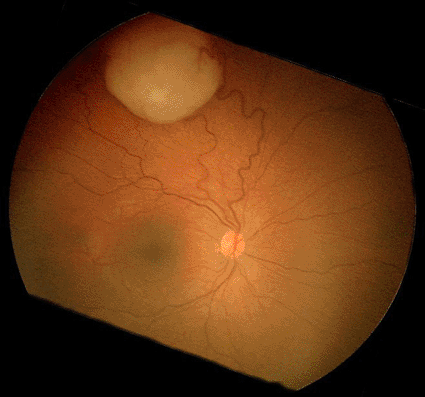 Image: Funduscopic finding of a retinoblastoma (Photo courtesy of Meilahti Hospital, Department of Ophthalmology).